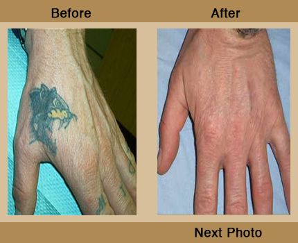 The Q Factor Laser Clinic UK - Tattoo Removal Company in Torquay (UK)
