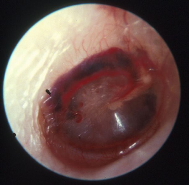 barotrauma ear mri barotrauma ear mri