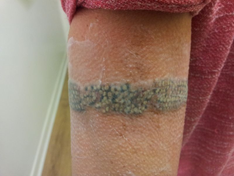 birstall body art tattoo removal company in birstall birstall body art tattoo removal company in birstall