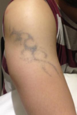 glasgow tattoo removal tattoo removal company in glasgow glasgow tattoo removal tattoo removal company in glasgow