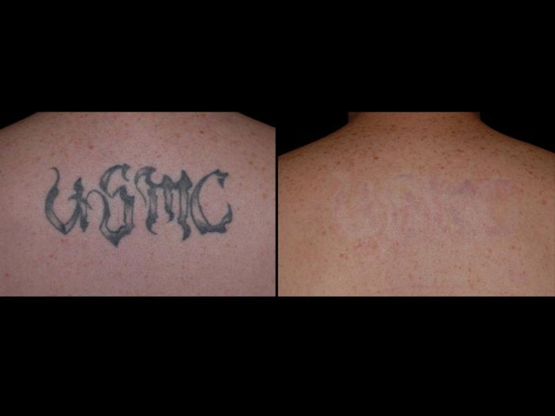 west london tattoo removal tattoo removal company in west london tattoo removal tattoo removal company in