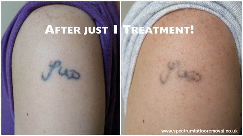 Spectrum Tattoo Removal Spectrum Tattoo Removal